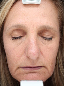 Case # 21 after photo