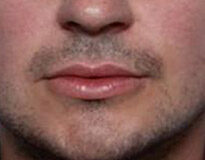 Case # 5 after photo