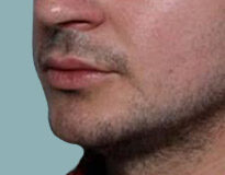 Case # 5 after photo