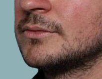 Case # 5 before photo