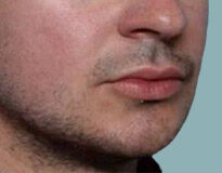 Case # 5 after photo