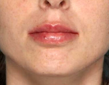 Case # 11 after photo