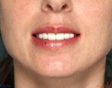 Case # 11 after photo