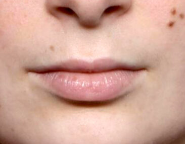 Case # 10 before photo