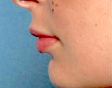 Case # 10 after photo