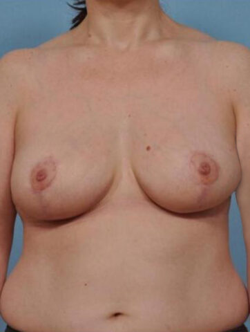 Case # 3 after photo