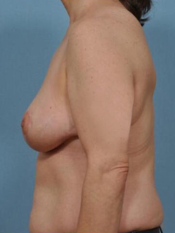 Case # 3 after photo