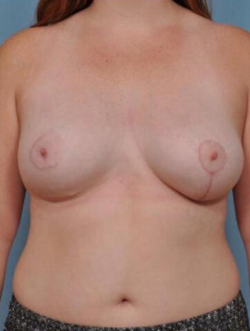 Case # 1 after photo