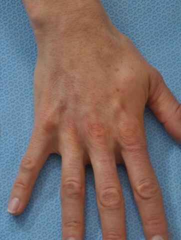 Case # 2 after photo