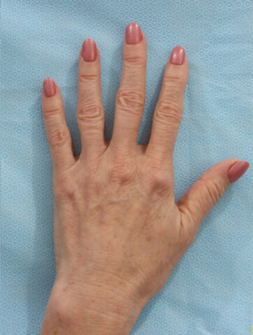 Case # 1 after photo