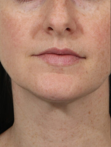 Case # 1 after photo