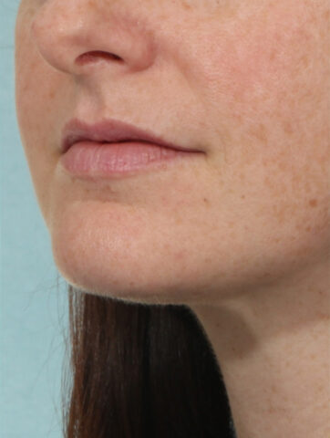 Case # 1 after photo