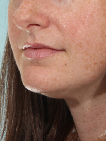 Case # 1 before photo