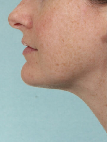 Case # 1 after photo