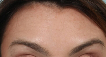 Case # 4 after photo