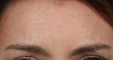 Case # 4 after photo