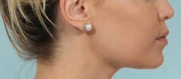 Case # 13 after photo