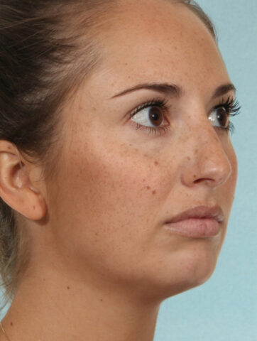 Case # 5 before photo