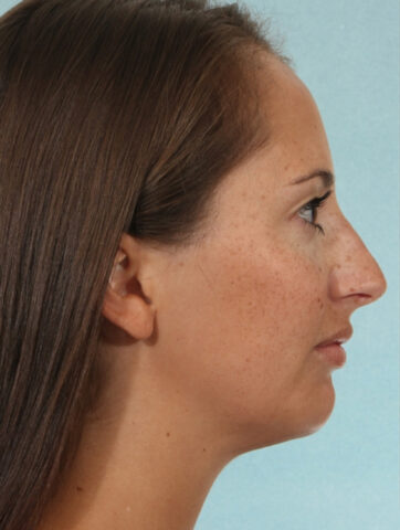 Case # 5 after photo