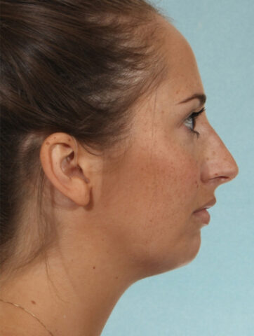 Case # 5 before photo