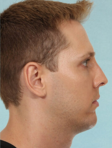 Case # 4 after photo