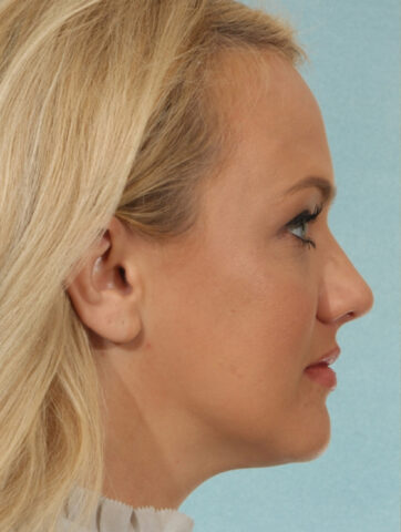 Case # 3 before photo