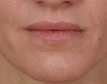 Case # 8 after photo