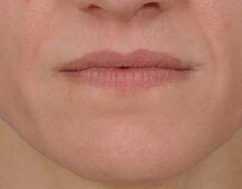 Case # 8 before photo