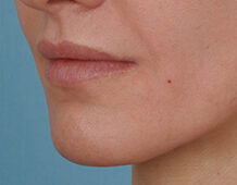 Case # 8 after photo