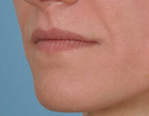 Case # 8 before photo