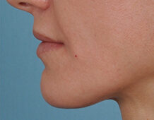 Case # 8 after photo