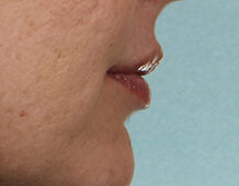 Case # 7 after photo