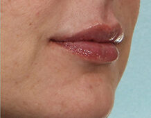 Case # 7 after photo