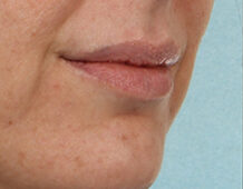 Case # 7 before photo