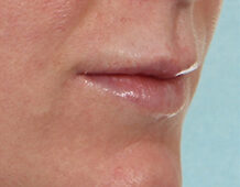 Case # 19 after photo