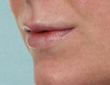 Case # 19 after photo