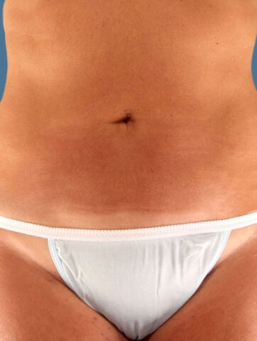 Case # 13 after photo