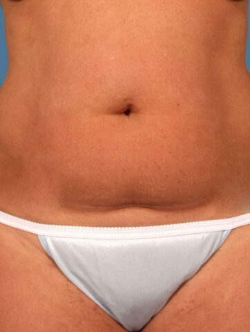 Case # 13 before photo