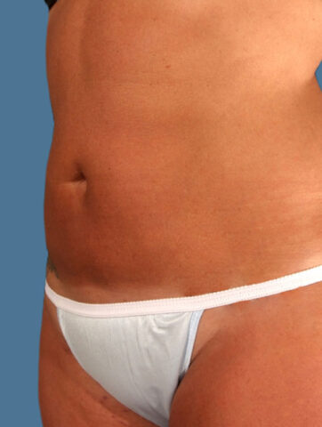 Case # 13 after photo