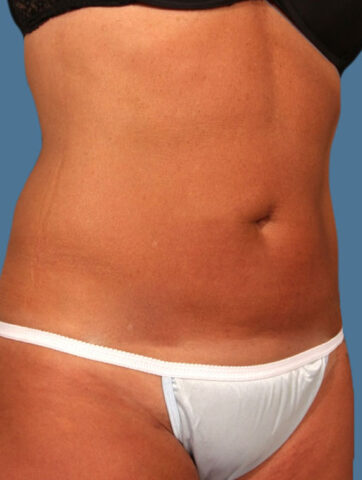 Case # 13 after photo