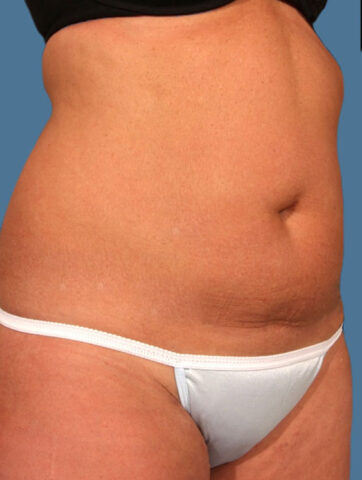 Case # 13 before photo