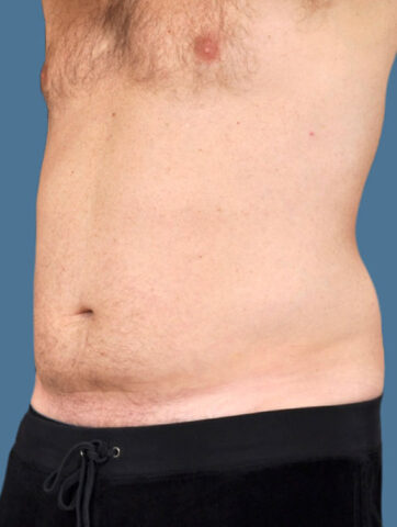 Case # 16 after photo