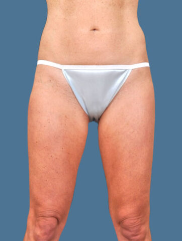 Case # 11 after photo