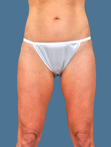 Case # 11 before photo