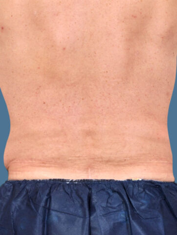 Case # 10 after photo