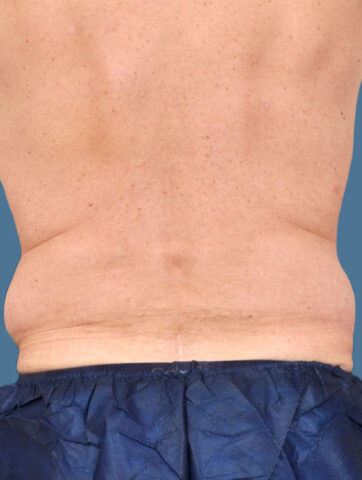 Case # 10 before photo