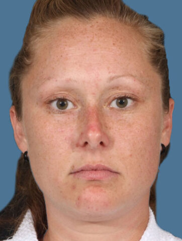 Case # 9 after photo