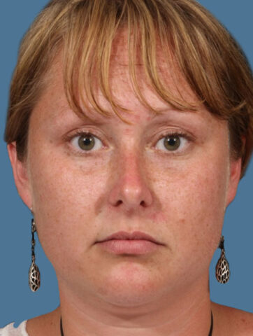 Case # 9 before photo