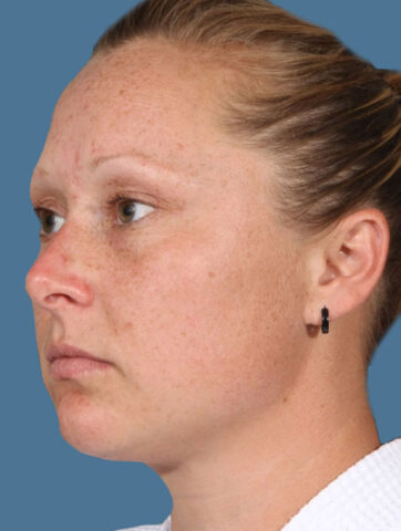 Case # 9 after photo