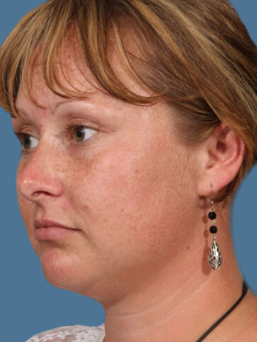 Case # 9 before photo